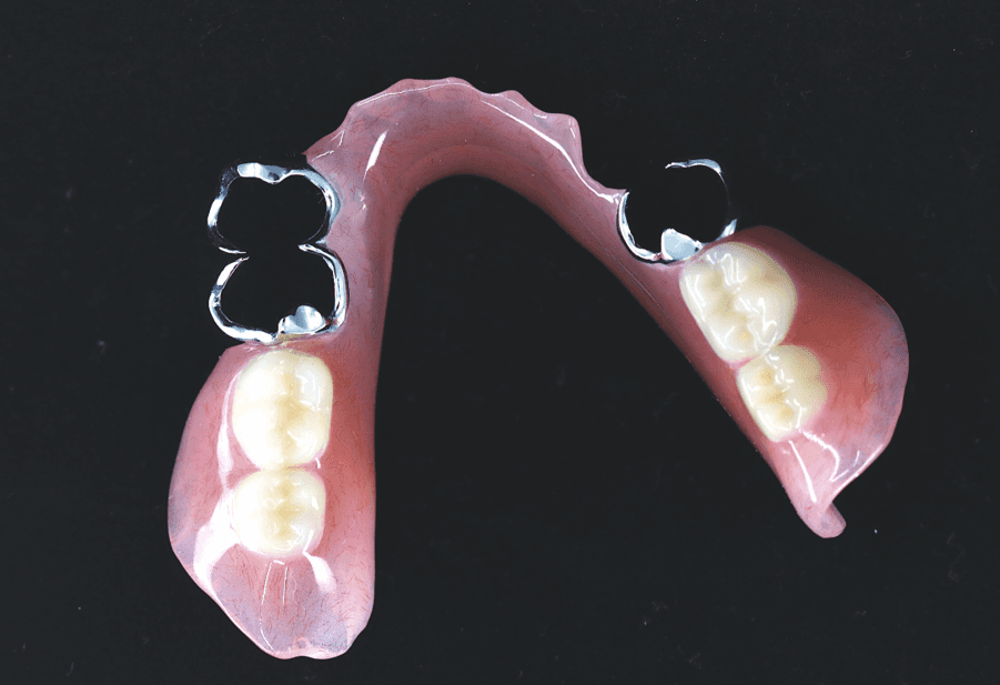 局部義歯(部分入れ歯)