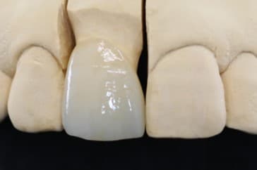 クラウン(歯の被せ物)